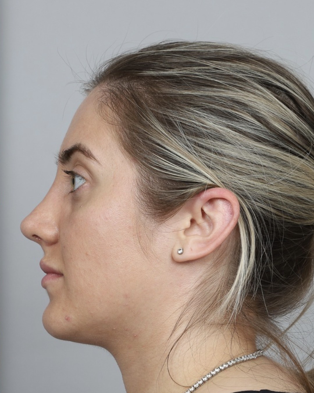 After rhinoplasty