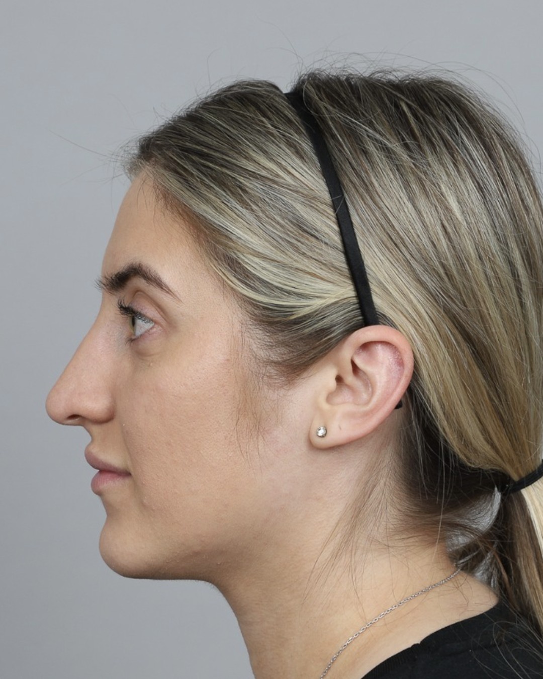 Before rhinoplasty