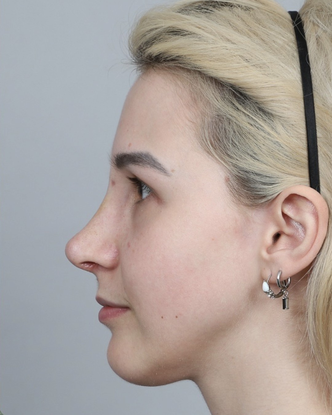 After rhinoplasty, profile