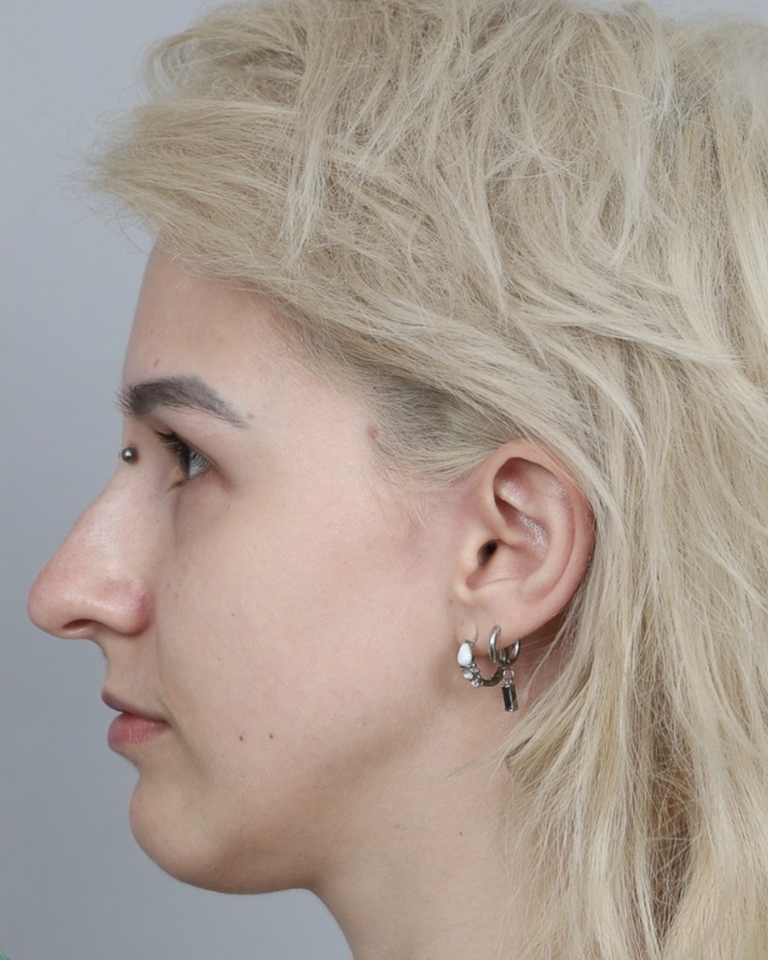 Before rhinoplasty, profile